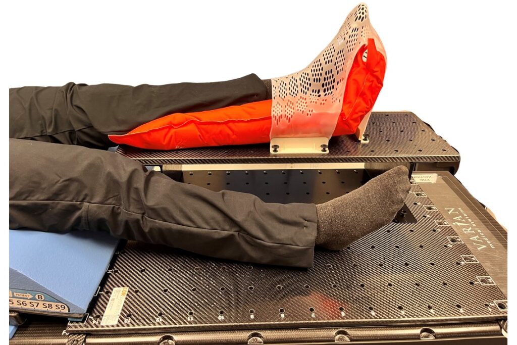 CDR ExtremityLock foot and ankle immobilization on LINAC couch